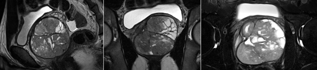 Non-Invasive Prostate MRI